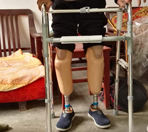 小腿假肢价格